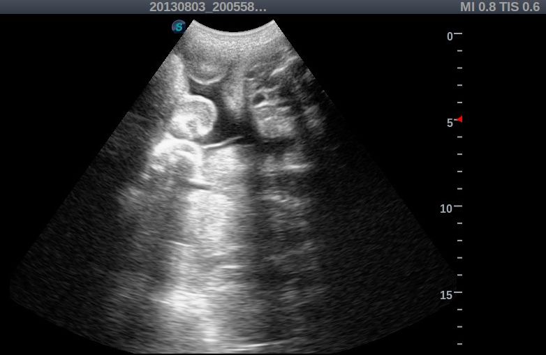 Cotyledons on ultrasound