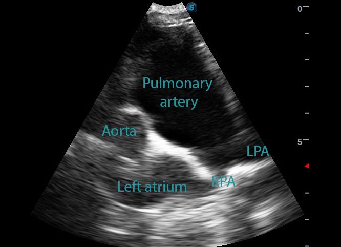 Dilated Canine Pulmonary Artery