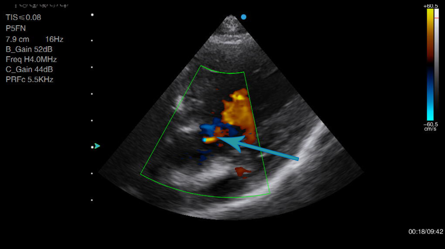 6 Year Old Dog With Subaortic Stenosis Animal Ultrasound Association