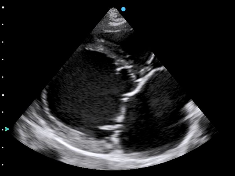 Dilated left atrium