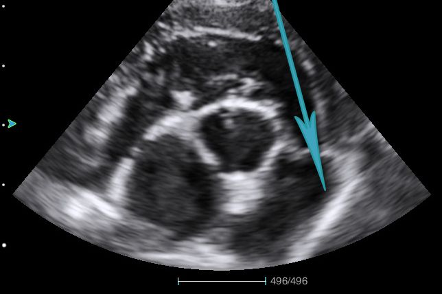 Checking for pulmonary stenosis