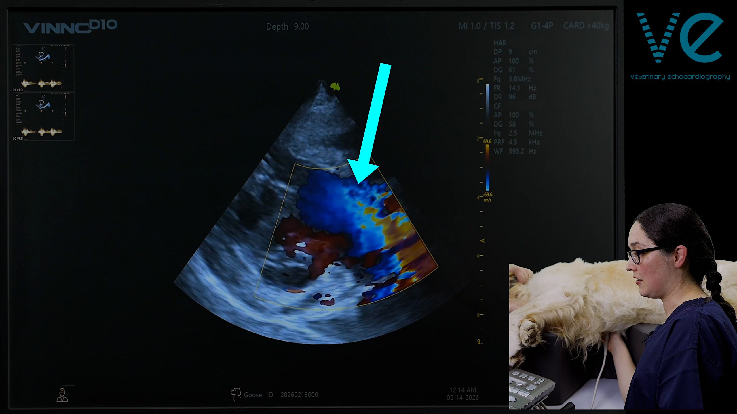Congenital Heart Defects